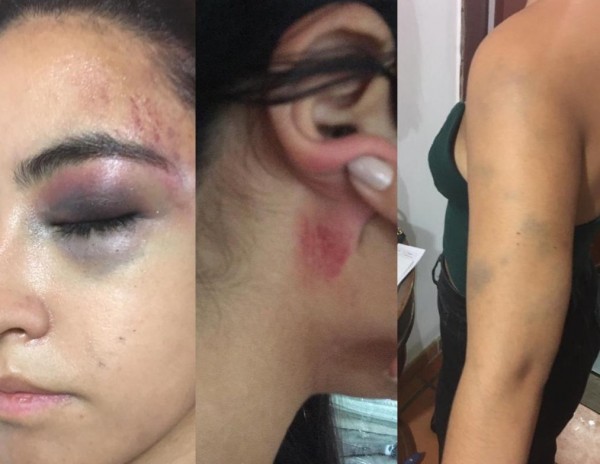 Lee más sobre el artículo Por una escena de celos, una joven de 19 años de edad, fue agredida físicamente y amenazada de muerte en Ibagué