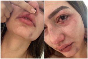Lee más sobre el artículo ¡Repudiable! Mujer fue agredida por su expareja sentimental luego de salir de una discoteca en El Líbano