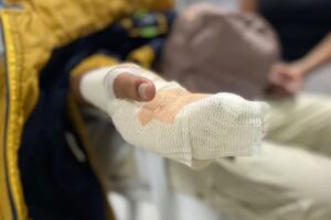 Lee más sobre el artículo Un joven de 21 años es el quinto caso de quemado con pólvora en Ibagué