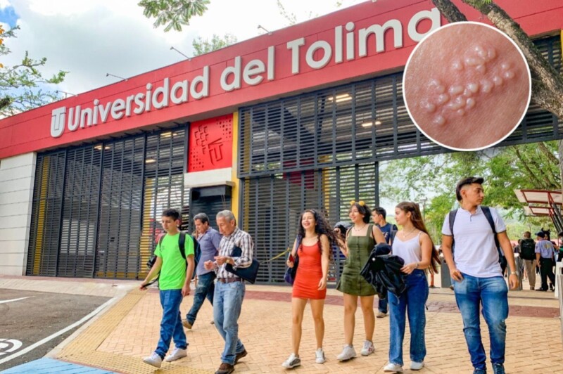 En este momento estás viendo Desmienten brote de herpes al interior de la Universidad del Tolima