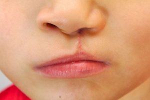 Lee más sobre el artículo Unitrauma y Dibujando Alegría unen esfuerzos para realizar más de 60 cirugías de labio leporino en Ibagué